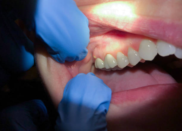 Best Broken or Chipped Tooth Repair in Broomfield, CO